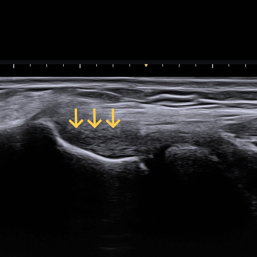 팔꿈치의 건병증(테니스엘보)에서 보이는 힘줄의 미세파열