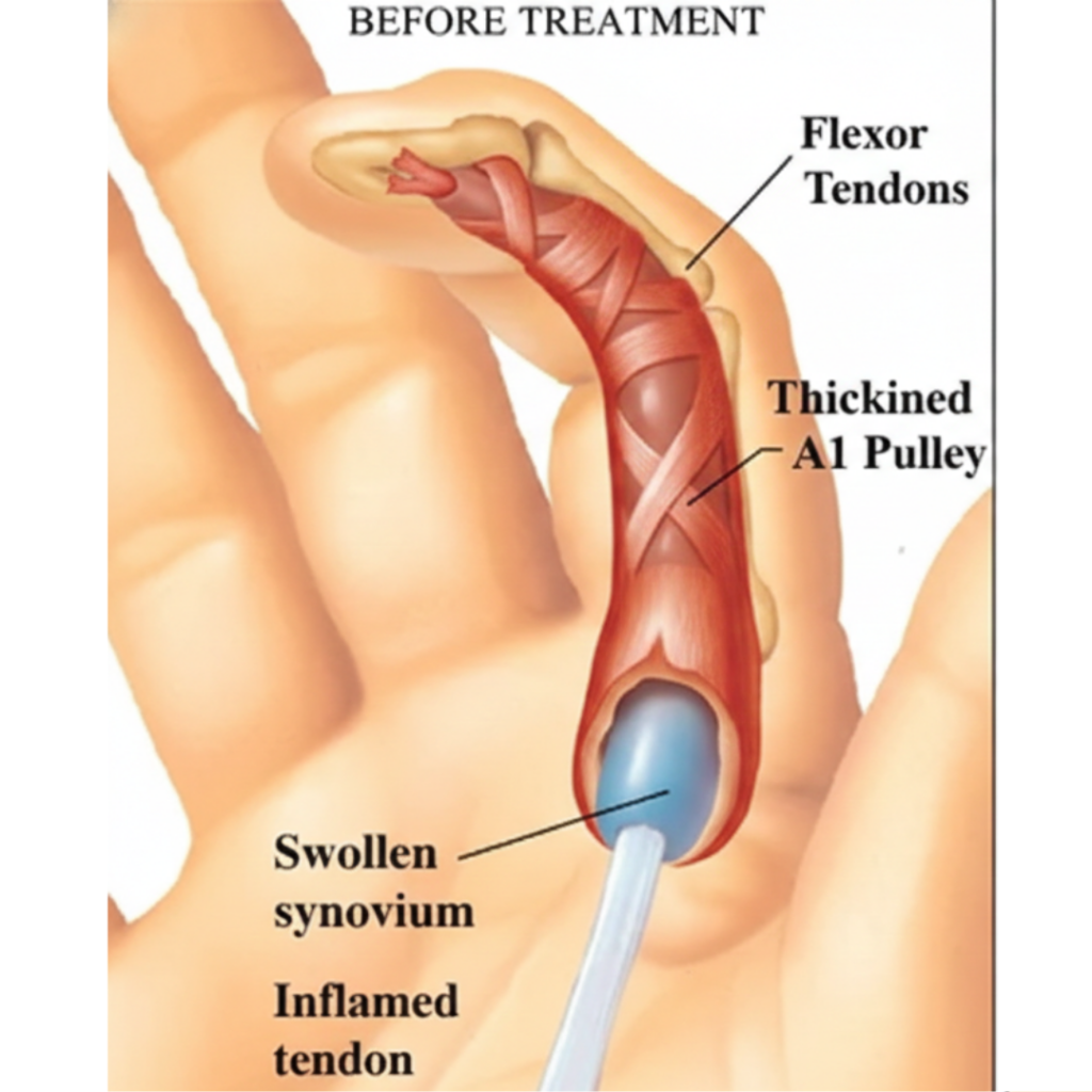 방아쇠 수지의 구조